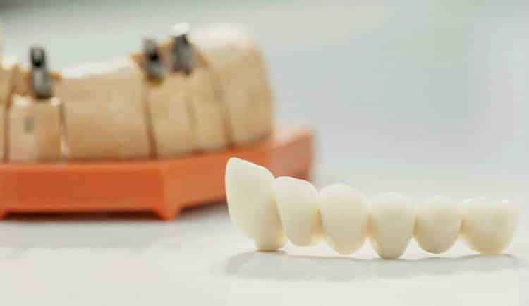 resina dentale modelli gengive denti corone ponti