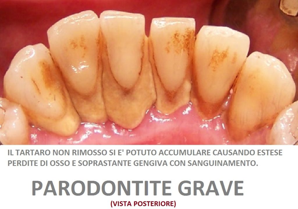 Curare la parodontite – Dentista Implantologia Prezzi