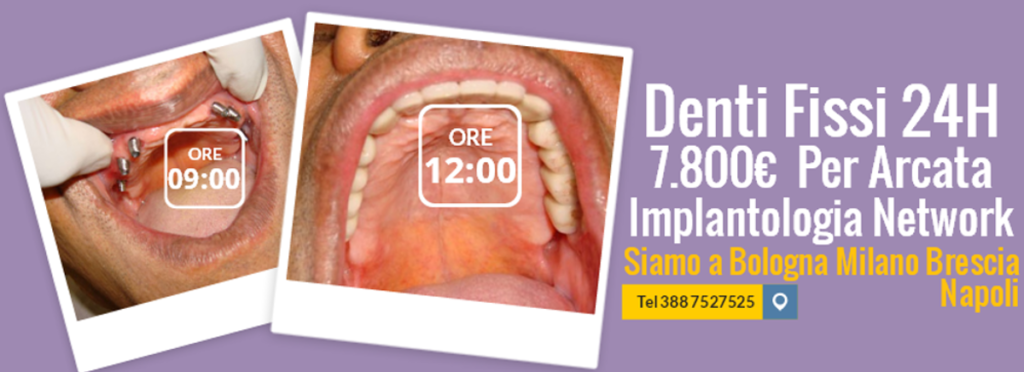 Dentista Implantologia Prezzi