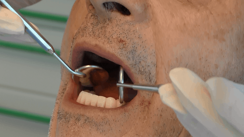 Impianti Dentali A Carico Immediato Dentista Implantologia Prezzi